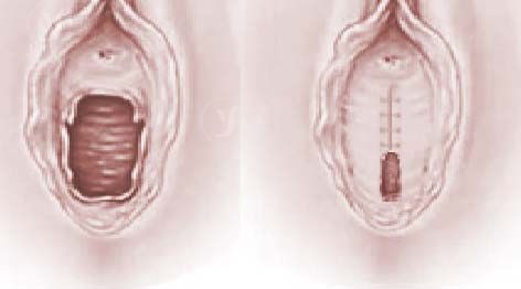 hymenoplasty Thailand
